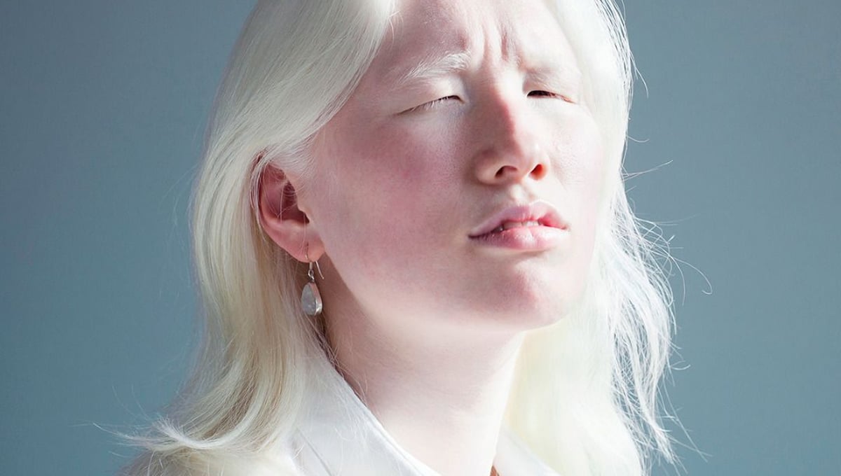 A DIFFERENT LOOK - a closer look on albinism. (ANDERS KIJKEN)