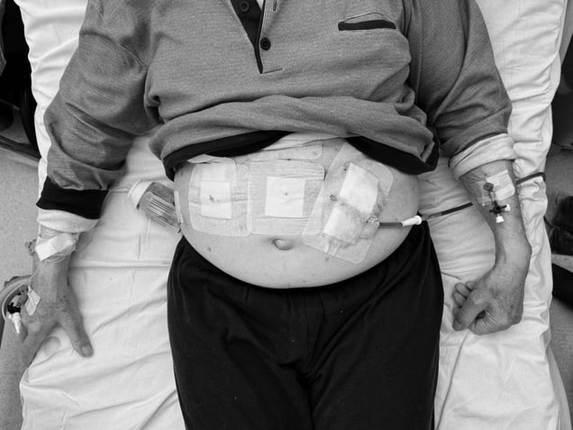 After part of his liver was removed