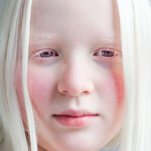A DIFFERENT LOOK - a closer look on albinism. (ANDERS KIJKEN)