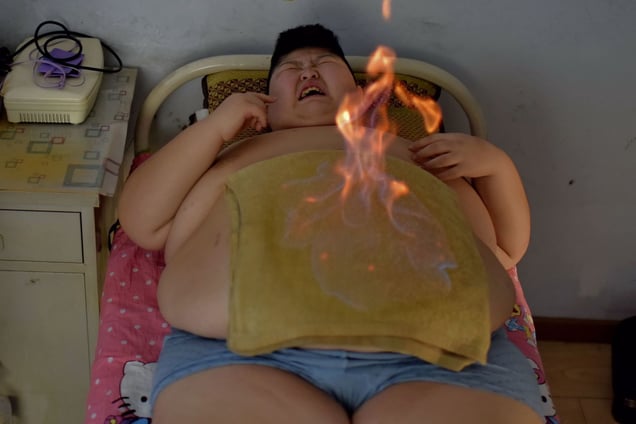 "November 25th,2016, Changchun city, Jilin province, China. Fire treatment is another weight loss treatment. Ingredients are applied to the body’s meridian system, with the fire process unblocking meridian points that hinder the speed of the body’s metabolic processes, all with the aim of transforming fat into energy that can be eliminated from the body.