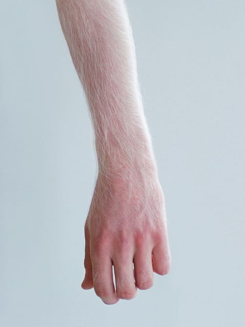 A DIFFERENT LOOK - a closer look on albinism. (ANDERS KIJKEN)