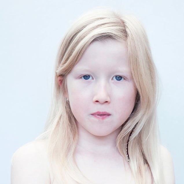 A DIFFERENT LOOK - a closer look on albinism. (ANDERS KIJKEN)