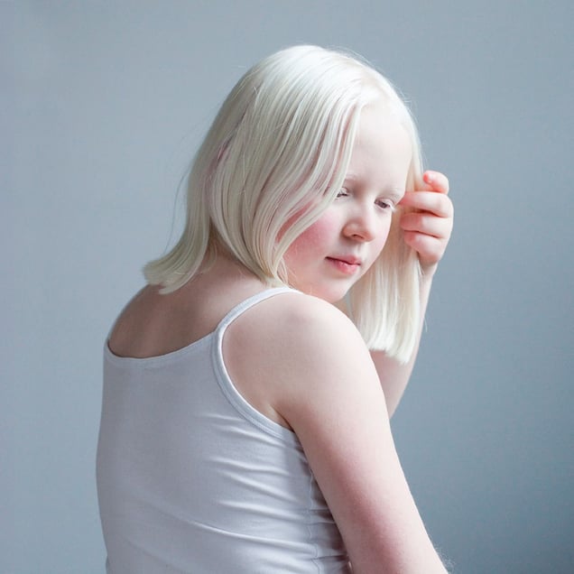 A DIFFERENT LOOK - a closer look on albinism. (ANDERS KIJKEN)