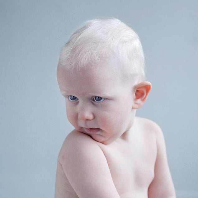 A DIFFERENT LOOK - a closer look on albinism. (ANDERS KIJKEN)