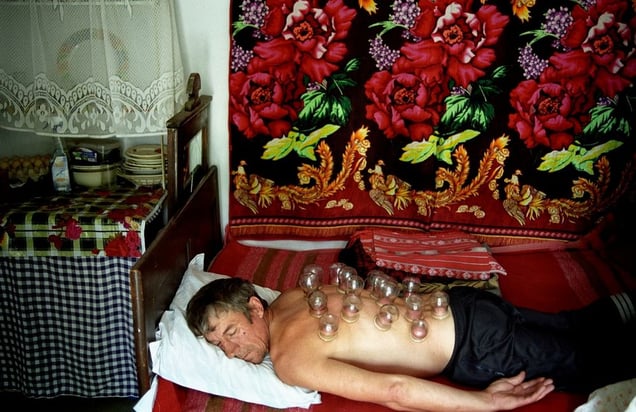 Romania, Caraorman, Danube Delta. A man is receiving a traditional pain release with suction cups© Petrut Calinescu