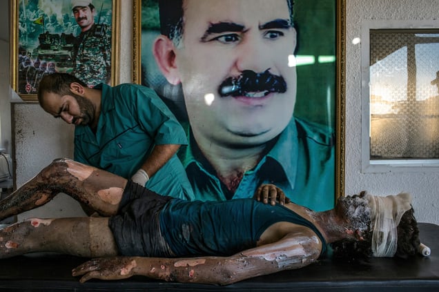 A doctor rubs ointment on the burns of a 16-year-old Islamic State fighter namedJacob in front of a poster of Abdullah Ocalan, the jailed leader of the KurdistanWorkers' Party, at a Y.P.G. hospital compound on the outskirts of Hasaka, Syria on 01 August 2015.