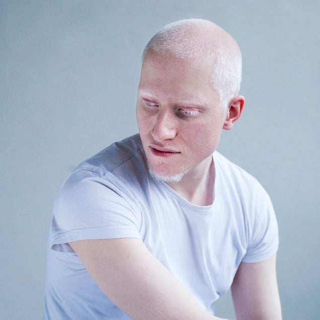 A DIFFERENT LOOK - a closer look on albinism. (ANDERS KIJKEN)
